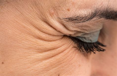 how to remove crows feet wrinkles